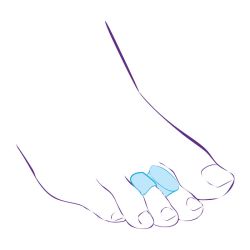 Перегородка межпальцевая совмещенная с протектором сустава СТ-54.6  Trives